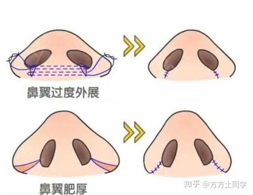 鼻翼缩小手术的基本费用构成