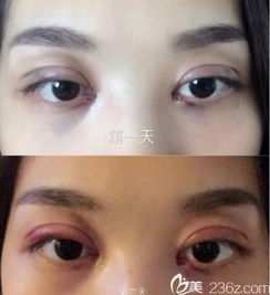 埋线双眼皮的基本价格构成