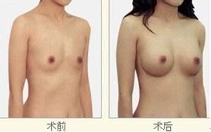 玻尿酸隆胸的基本价格构成