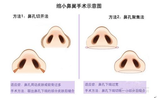 鼻综合手术价格构成解析