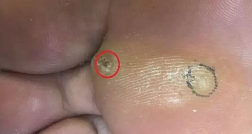 激光去鸡眼的基本原理与优势