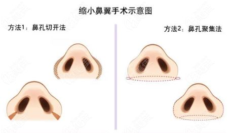 缩小鼻翼手术的价格构成