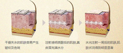 水光针价格构成与基础认知