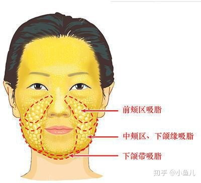 面部吸脂价格构成分析