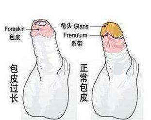 包皮过长手术费用构成解析