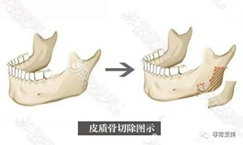 削骨手术的基本价格范围