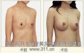 副乳手术价格区间概述