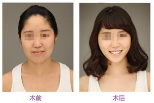 隆胸手术的基本价格范围