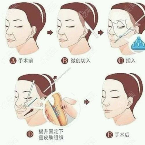 拉皮手术的基本价格构成