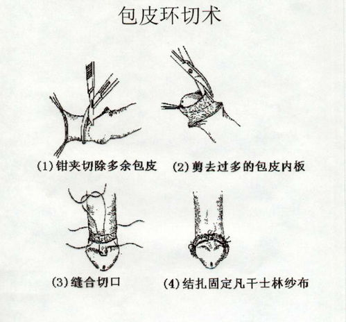 包皮环切术的基本费用构成