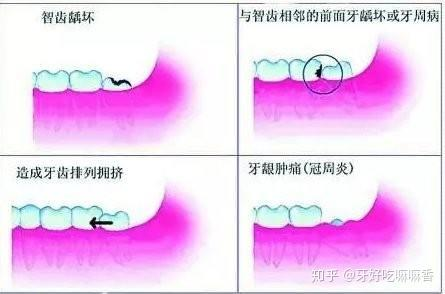 智齿拔除费用构成