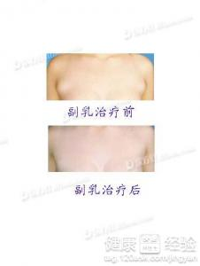 副乳手术的基本费用构成