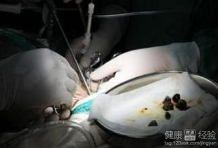 尿结石碎石的基本费用构成