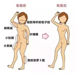 吸脂减肥的基本价格范围