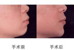 玻尿酸下巴价格概述
