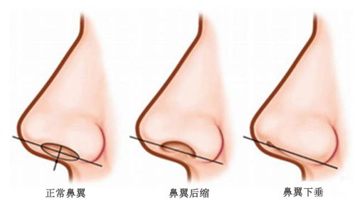 鼻头缩小手术概述与价格范围