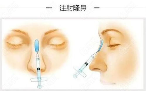注射隆鼻的基本概念与优势