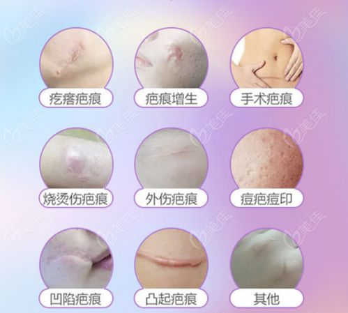 疤痕修复的基本价格构成