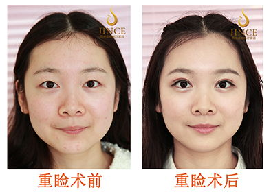 韩式三点双眼皮手术概述