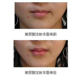 丰唇价格概述：丰唇多少钱因方法而异