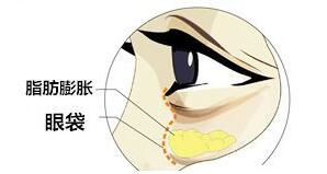 眼袋全切手术的价格构成