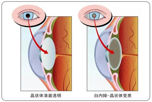 白内障手术费用影响因素