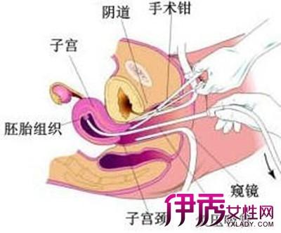 清宫手术的基本费用构成