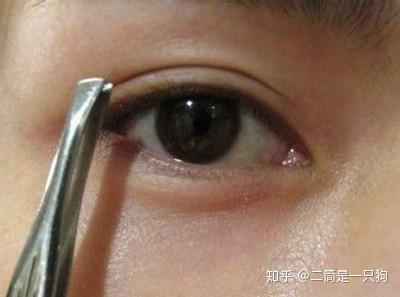 眼皮抽脂价格的基本构成