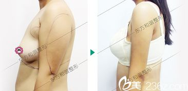 手臂抽脂的基本价格构成