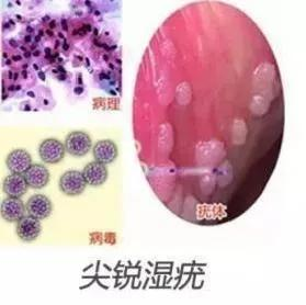尖锐湿疣治疗费用构成分析