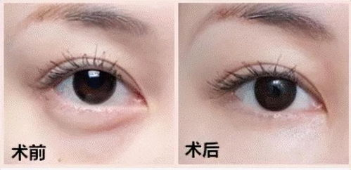 去眼袋手术的基本价格构成