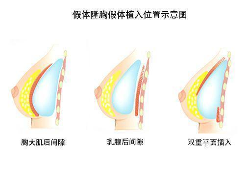 假体隆胸手术的基本价格构成
