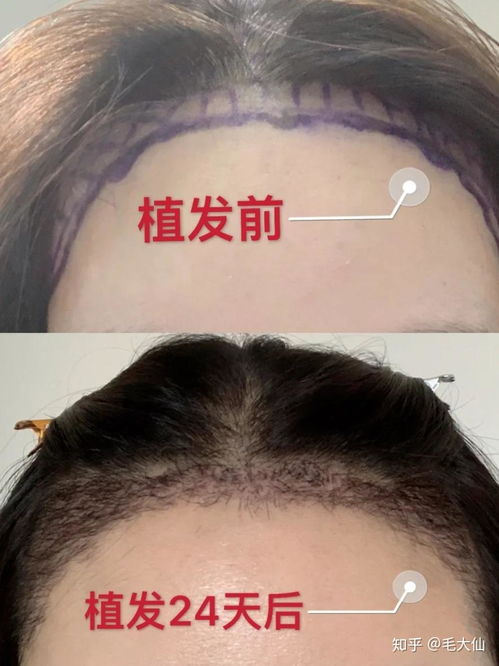 发际线种植的基本价格构成