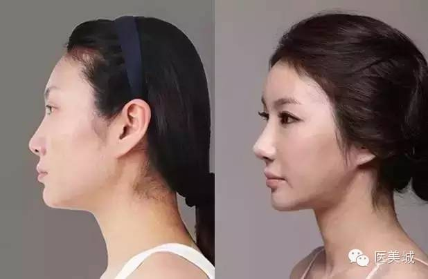 一针隆鼻的基本概念与原理