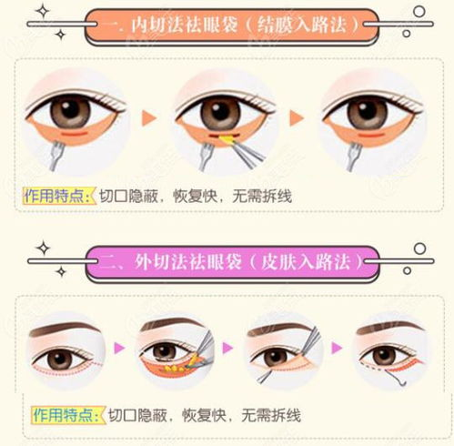 眼袋手术价格构成及基本费用范围