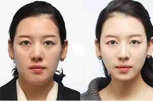 瘦脸针的基本概念与价格范围
