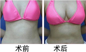 隆胸手术价格概述
