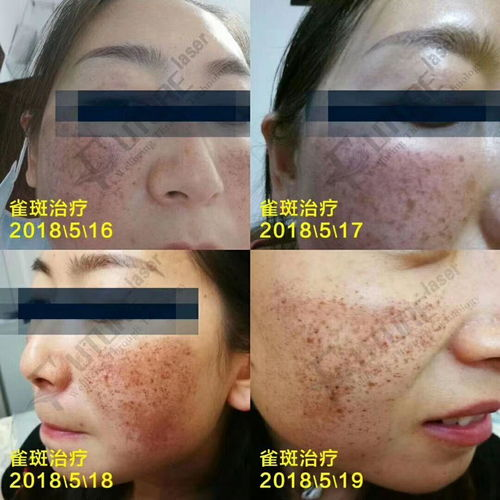 e光祛斑的基本概念与原理