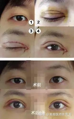 眼部吸脂手术的基本费用构成