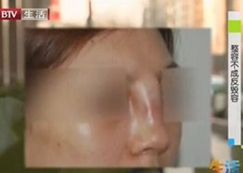 隆鼻手术价格概述