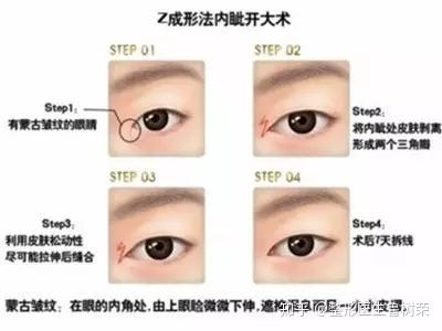 割双眼皮和开眼角手术的基本价格范围