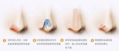 鼻尖整形价格影响因素