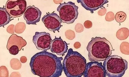 一、了解自身免疫性溶血性贫血