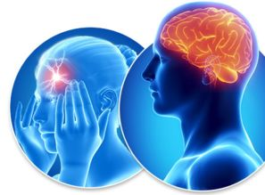 一、了解神经性头痛的成因