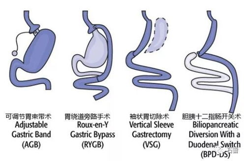 三、手术前的考虑因素