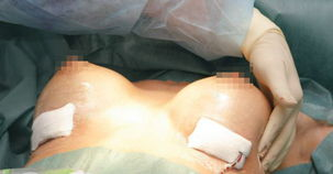 二、隆胸手术的极限尺寸