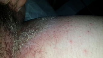 二、瘙痒的原因