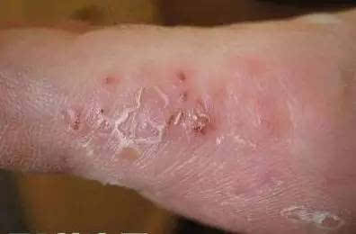 三、如何应对水泡瘙痒